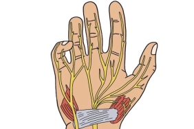 Akıllı Telefon Kullanımı ile Karpal Tünel Sendromu Arasındaki İlişki