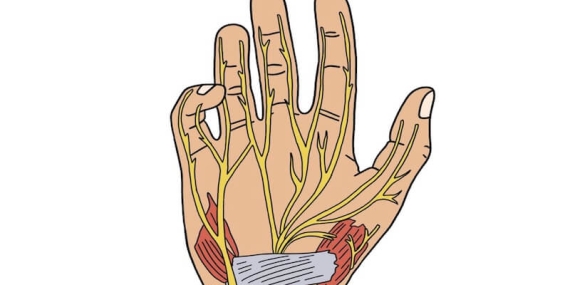 Akıllı Telefon Kullanımı ile Karpal Tünel Sendromu Arasındaki İlişki